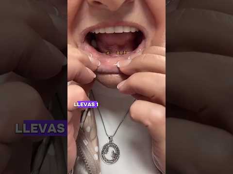 Así conseguirás que tú sobredentudura sobre 4 implantes locator se convierta en una prótesis fija