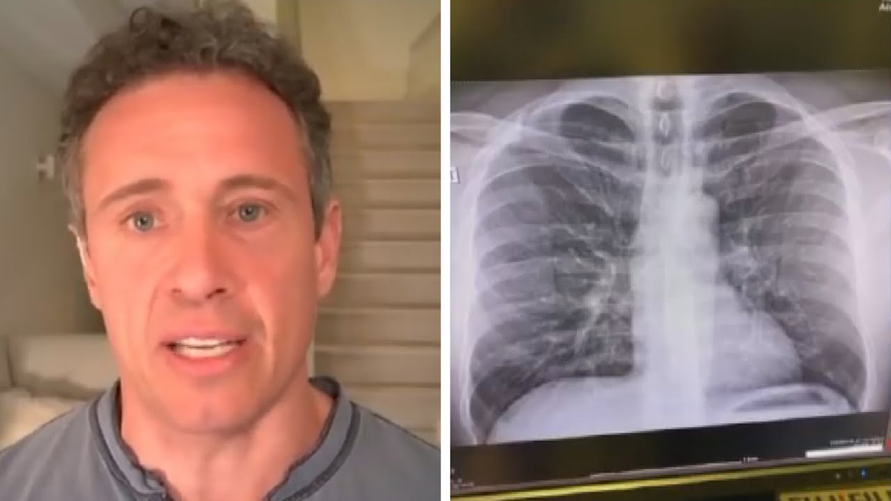 Chris Cuomo Shares Chest X Ray Amid Covid 19 Battle Youtube