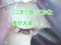 歯科検診　巨大虫歯多数