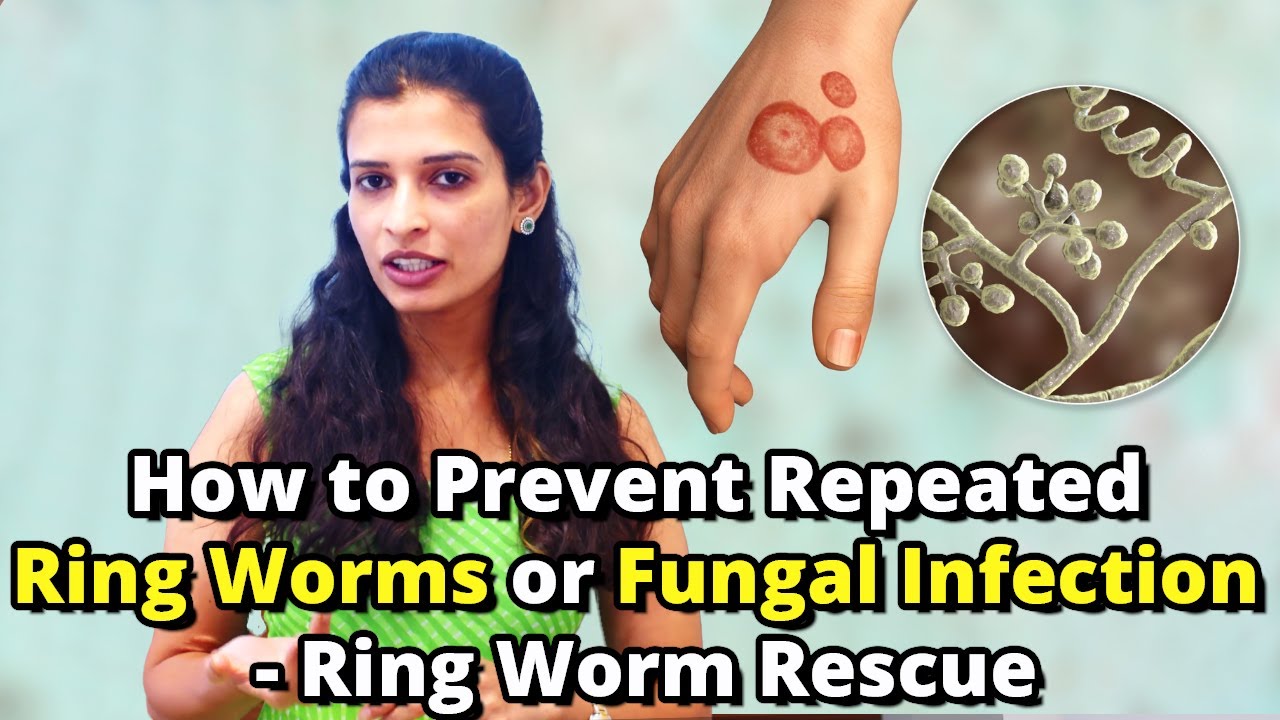 Fungal Infection Cream - Know About Ringworm, Jock Itch, Athlete's Foot -  Ring-Out