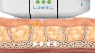 How the Ultherapy Treatment Works