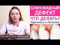 Клиновидный дефект - причины, симптомы, лечение клиновидного дефекта.