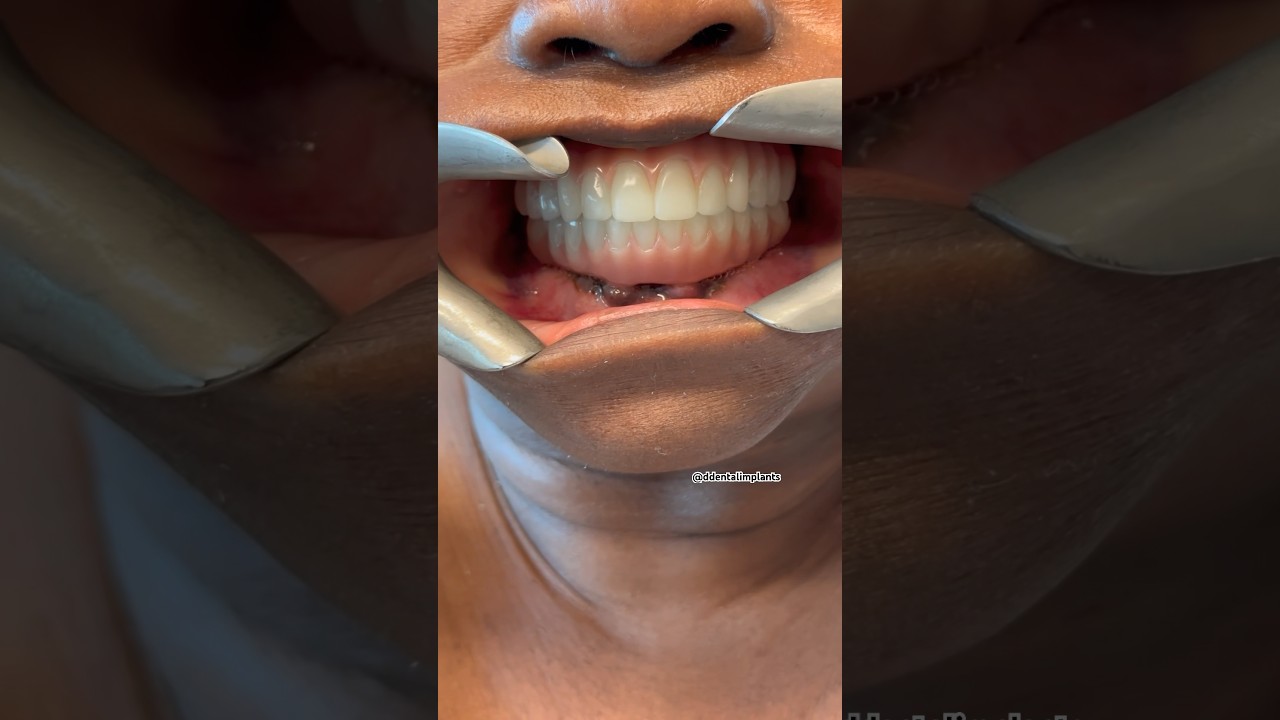 Permanent teeth in 24 hours 