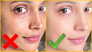 Remove Pigmentation, Dark Spots & Acne Scars| Anti-Aging & Skin Lightening Cream