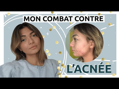 Mon combat contre l’acné