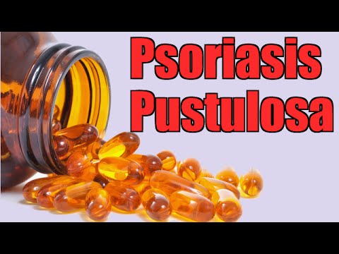 Tratamiento psoriasis medicina natural