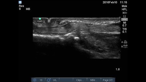 Trigger thumb on ultrasound