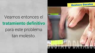 Lo llaman el “Rompe Hongos” por que una sola pasada elimina todos los Hongos de uñas