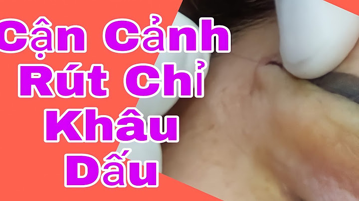 Hướng dẫn cách khâu rút chỉ năm 2024