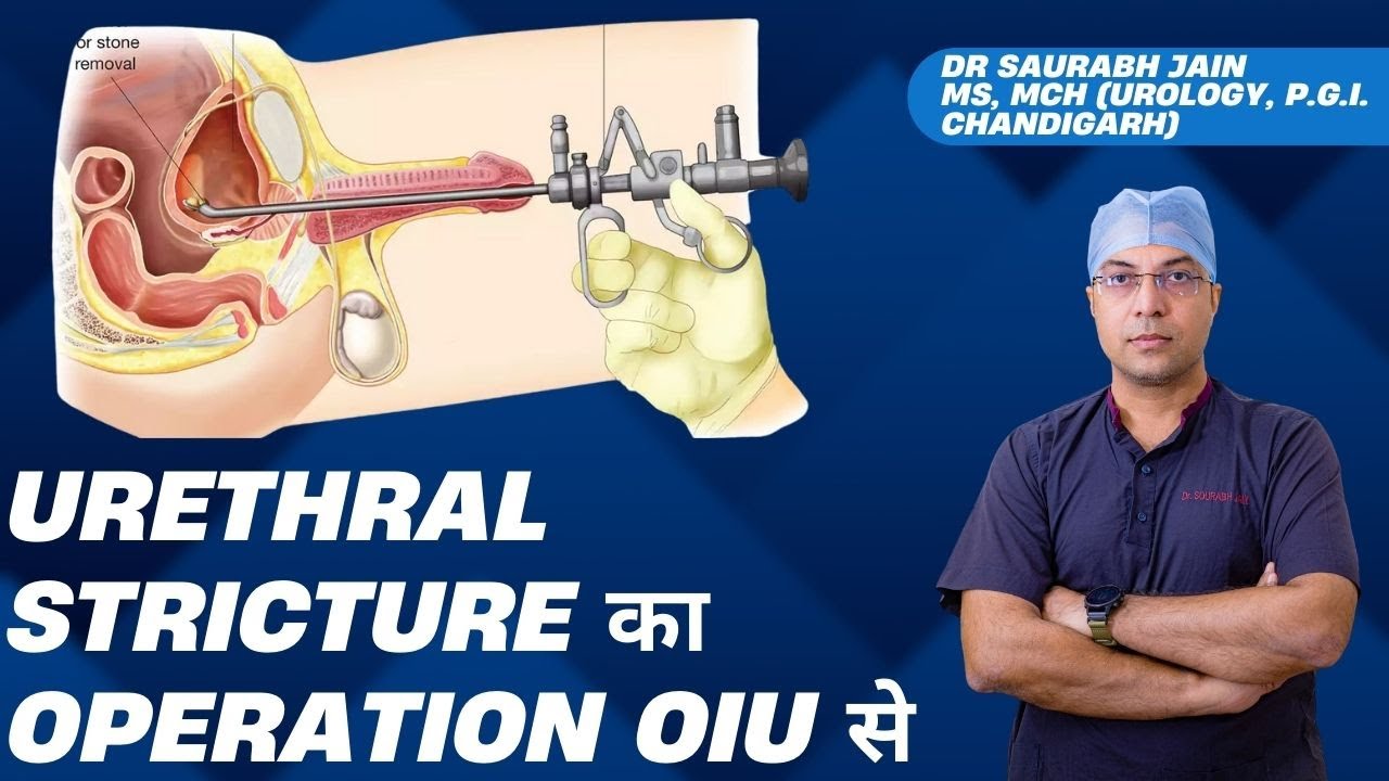 Urethral Stricture का Operation OIU से कैसे किया जाता है ?  OIU Procedure कैसे होती है ?