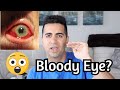 Bloody eye? Look no further!