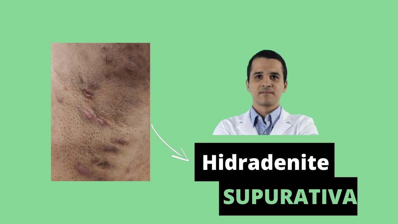 Hidradenite Supurativa Axilar