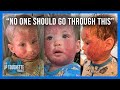 A Mother's Dire Warning About Topical Steroid Withdrawal | Tanya Gantiva Richards
