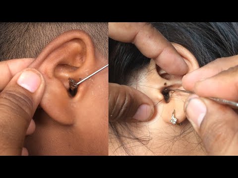 A large amount of earwax with closed ears-safe earwax, rhinitis treatment  ,Take Care Your Ears # 18