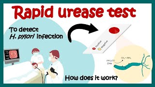 Rapid Urease Test | Rapid Urease test for detecting H Pylori infection | What is Rapid Urease Test?