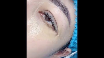 CẮT MÍ DƯỚI CÔNG NGHỆ DẤU CHỈ HIỆN ĐẠI TẠI VIỆN THẨM MỸ DIVA