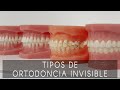 Tipos de ortodoncia invisible: alineadores invisibles, brackets Zafiro, brackets Incognito