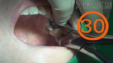 #18, #28 Extraction of Wisdom teeth with Forcep and Elevator -  상악 수직매복사랑니 포셉발치 , 엘리베이터발치 - 30