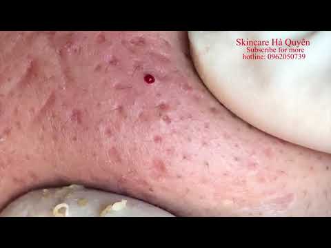 Video Blackheads and Acne treatment in Ha Quyen Spa on... - youtube