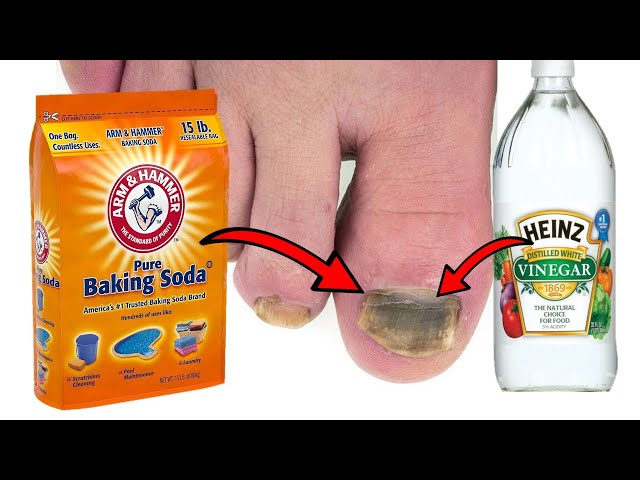 Black Toenail Fungus: What It Is and How to Treat It | Buoy