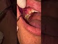 خراج الأسنان Dental Abscess Pus خراج الأسنان Dental Abscess Pus