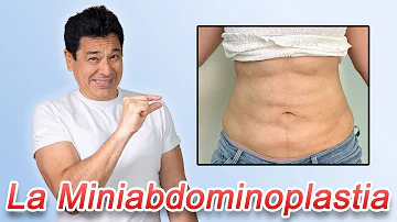 ¿Qué es una megaabdominoplastia?