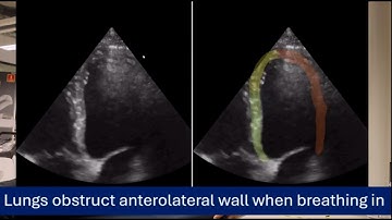 Regional quality demo for cardiac echo
