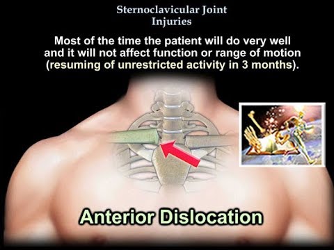 Sternoclavicular Joint Injuries - Everything You Need To Know - Dr. Nabil Ebraheim