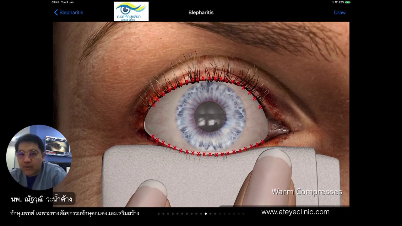 โรคาตาแห้ง หรือ โรคเปลือกตาอักเสบเรื้อรัง กับการรักษา