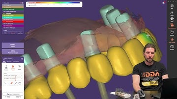 🚀 Scan Ladder: 15-Min Quick Full Arch Copy in Exocad! 🦷💻