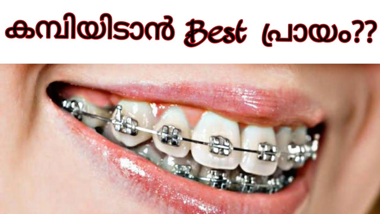 Best time for braces malayalam braces pallil kambi idunnath