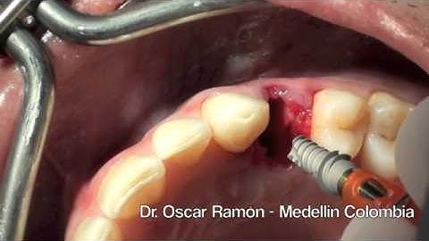 Saturno Maxillary Premolar