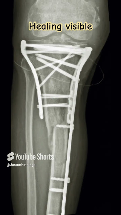 Dual Plating proximal tibia fracture #ortho #trauma #education