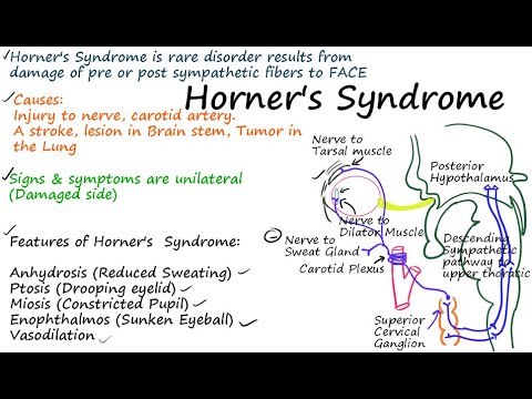 paquete bádminton Milagroso Pthophysiology of Horner's Syndrome - YouTube
