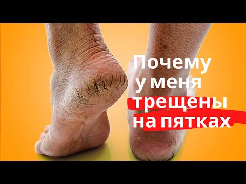 Трещины на пятках.