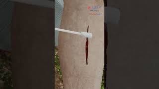 Emergency Suturing: 20-Second Skin Wound Repair #Medicalanimations