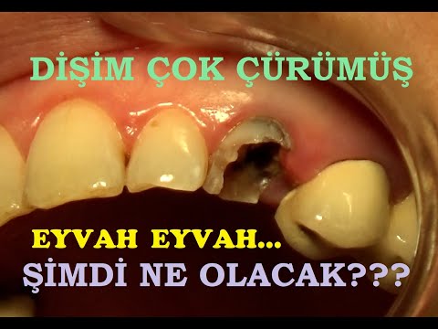 Dibinden Çürümüş ve Kırılmış Bir Dişe Ne yaptık?