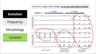 Clinical and Electrographic Seizures