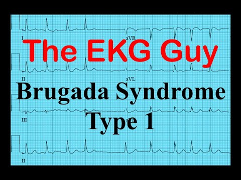 Ekg Ecg Brugada Syndrome Type 1 The Ekg Guy Www Ekg Md Youtube