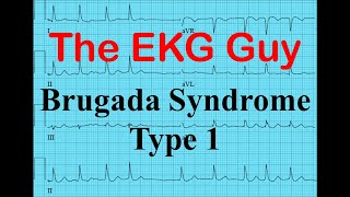 Ekg Ecg Brugada Syndrome Type 1 The Ekg Guy Www Ekg Md Youtube