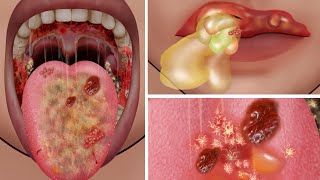 ASMR Treatment and Deep cleaning of burned tongue & lip | 사실 적 인 입술 및 트리트먼트 애니메이션