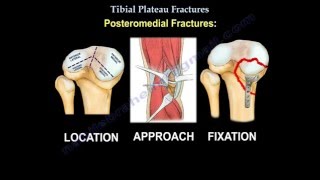 Tibial Plateau Fractures  Everything You Need To Know  Dr. Nabil Ebraheim