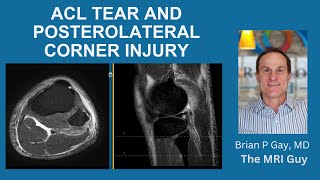 ACL TEAR WITH POSTEROLATERAL CORNER INJURY