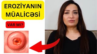 Eroziyanın müalicəsi VARMI? - Qadınlar izləsin!