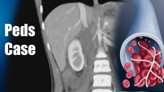 10 icd ivc thrombosis