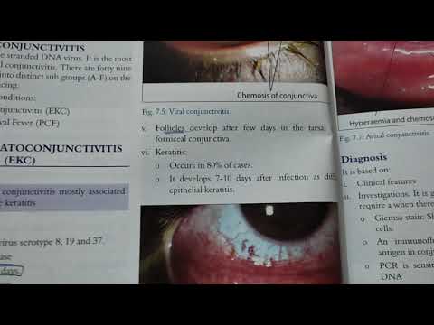 epidemic keratoconjunctivitis opthamology