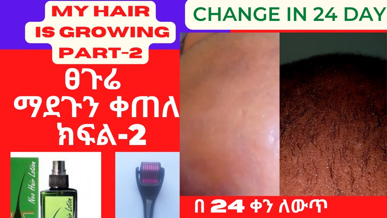 My Hair Is Growing PART2 How To Use Neo Hair Lotion & Derma Roller