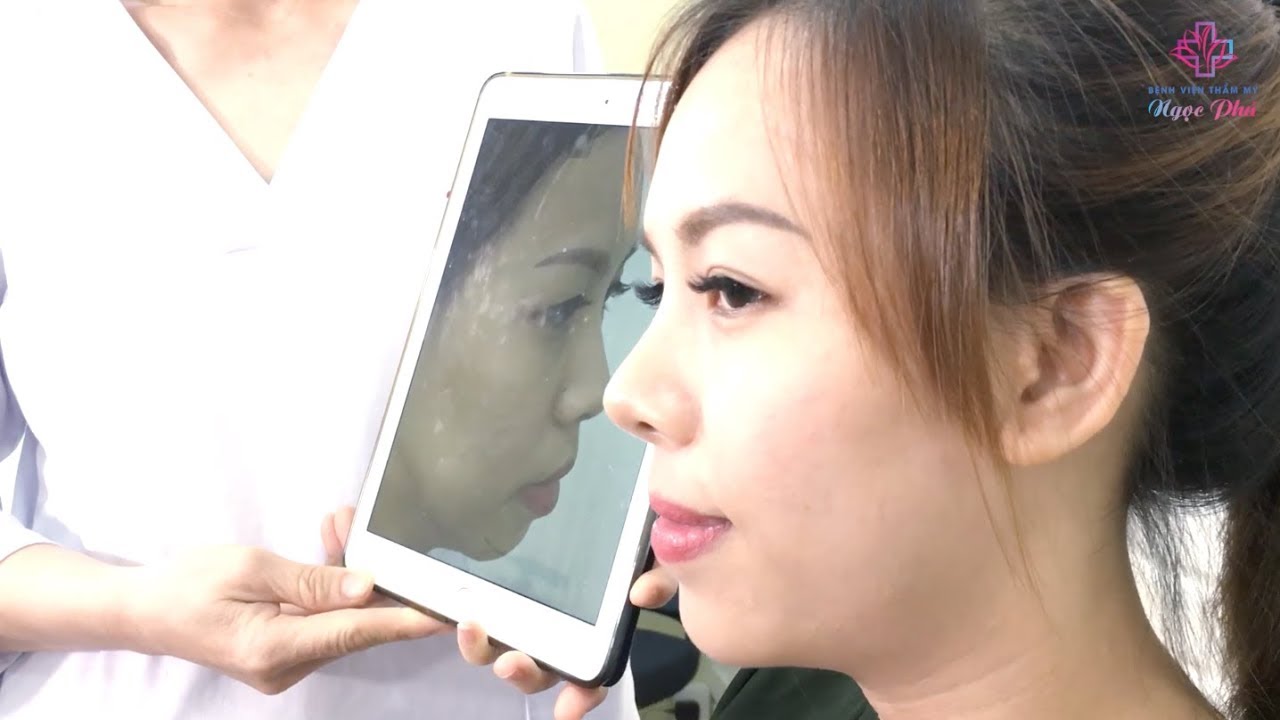bảng giá thẩm mỹ viện ngọc phú New 2022 Khách hàng Nâng mũi - Đặt cằm tại Bệnh viện Thẩm mỹ Ngọc Phú