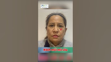 Bác sĩ Tú Dung Căng da mặt SMAS PRO trẻ tức thì chỉ sau 60 phút