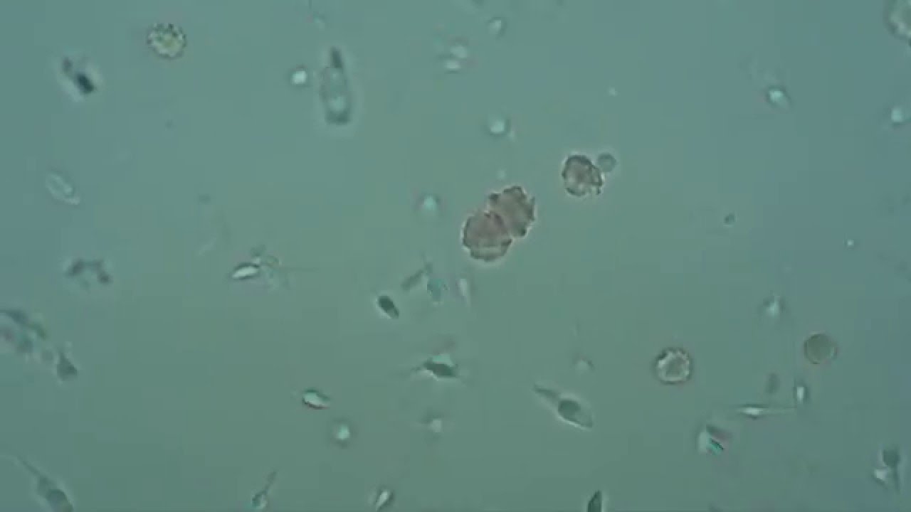 Гемоспермия. - YouTube